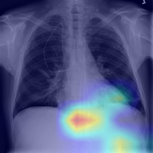 Pneumonia Detection